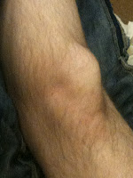 Busted Knee from Kinect