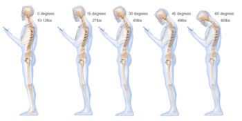 Surgeon develops an image of how texting warps your spine. We have a quick solution