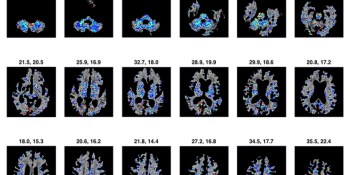 Darmiyan’s software detects early stages of Alzheimer’s