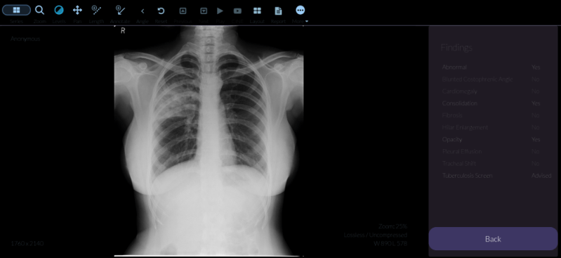 Qure.ai chest scan