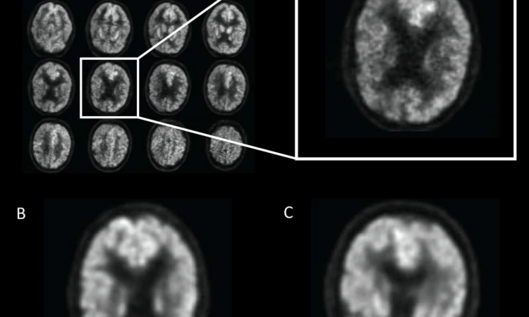 AI brain scan