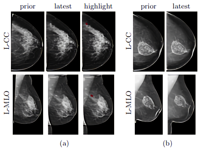 AI mammography 