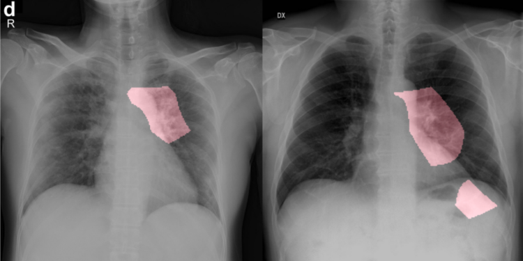A COVID-Net scan of a chest x-ray