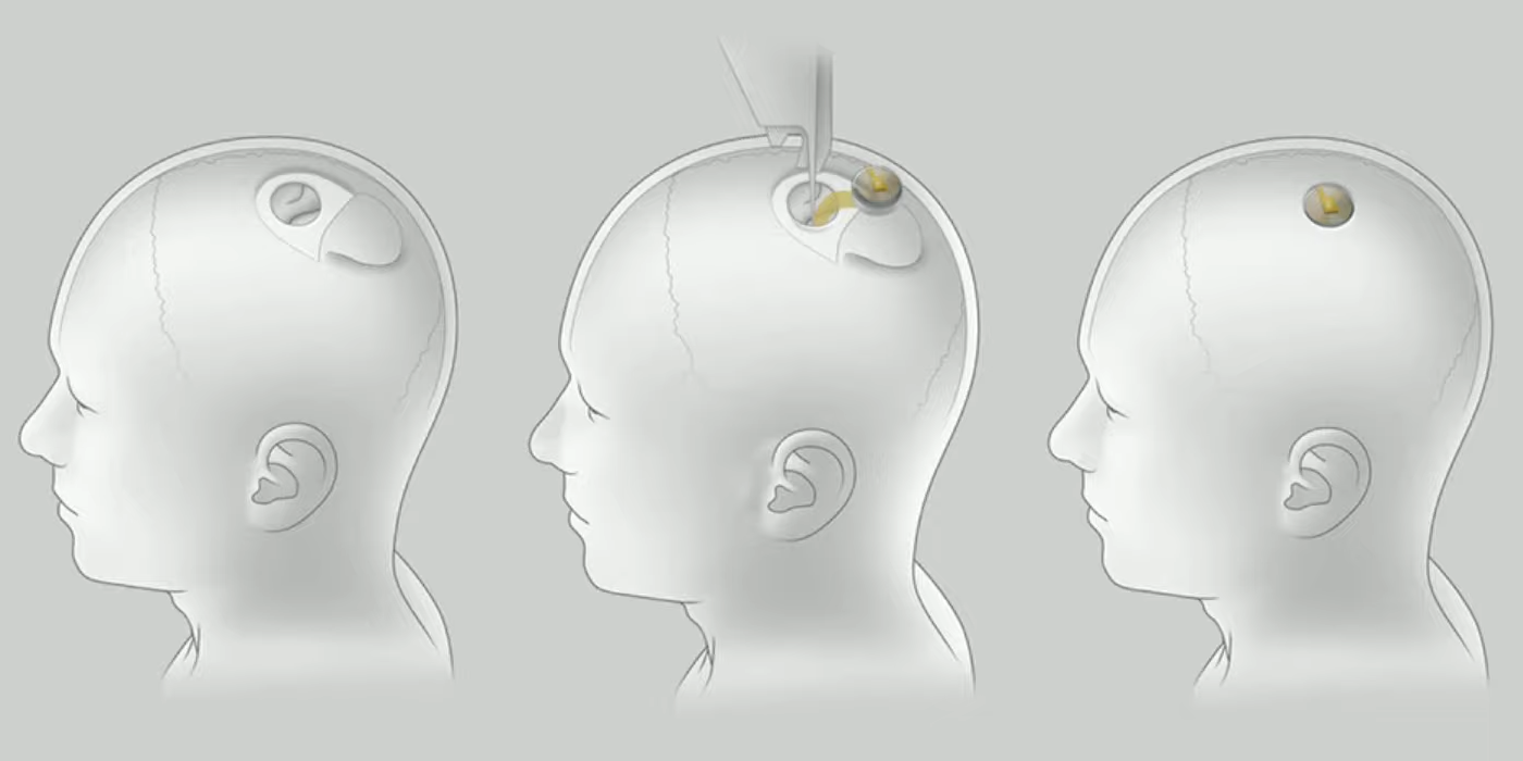 Neuralink surgery procedure